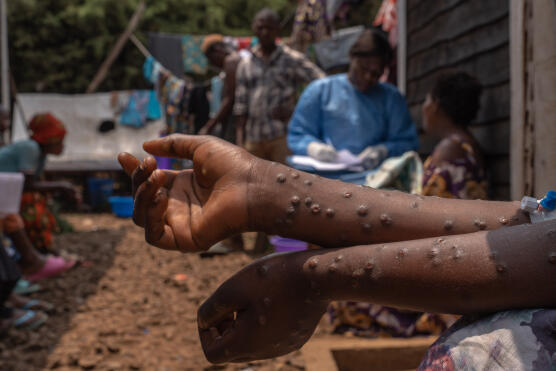 Mpox en Afrique : 866 décès depuis le début de l’année, selon l’agence sanitaire Africa CDC