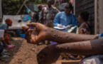 Mpox en Afrique : 866 décès depuis le début de l’année, selon l’agence sanitaire Africa CDC